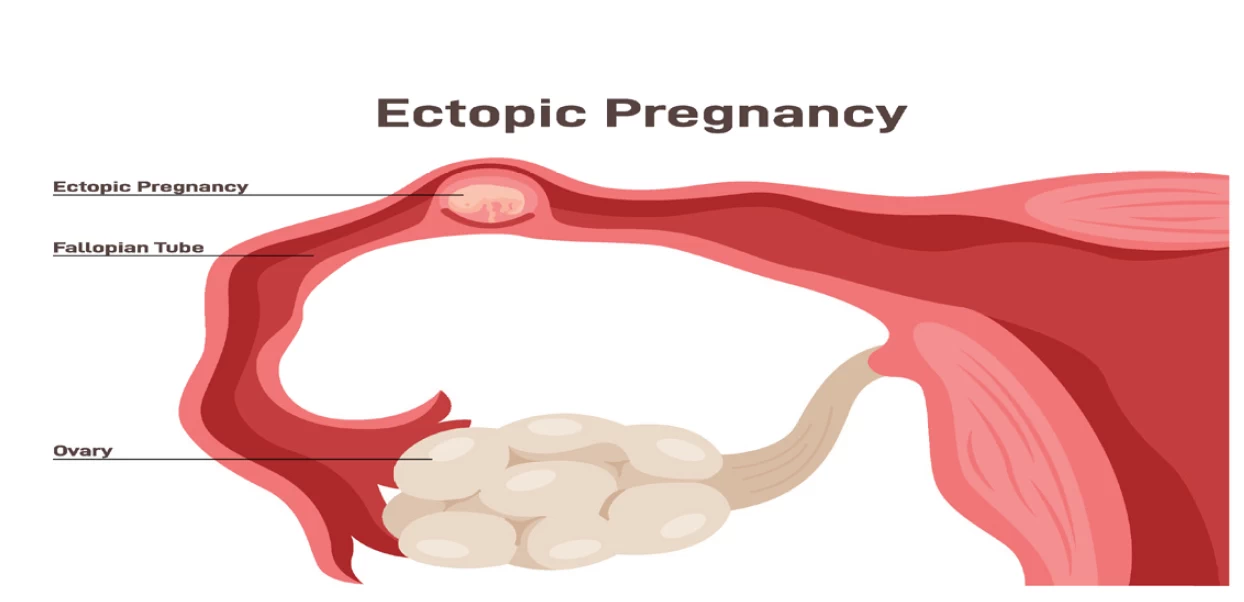 fig1-ectopic-factsheet.webp