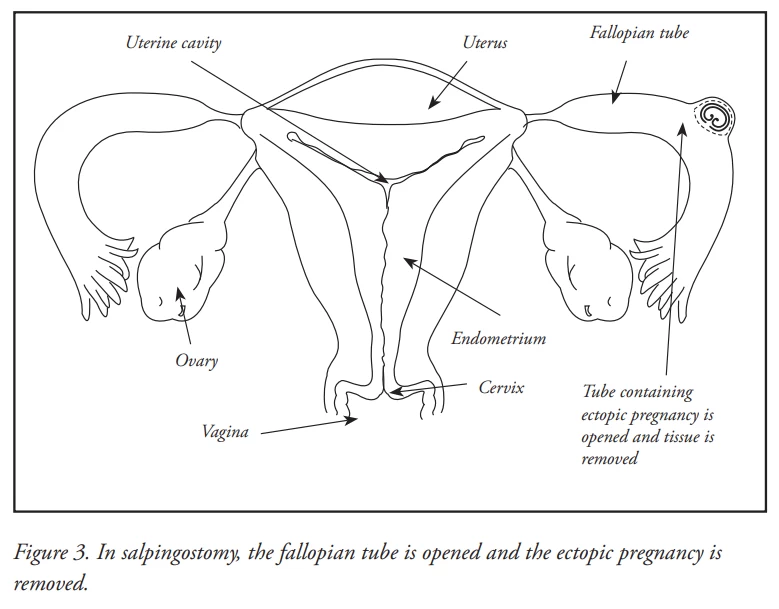 ectopic_fig3.webp