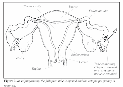 Dr.Kiruthiga Devi - Ectopic or tubal pregnancy occurs when the