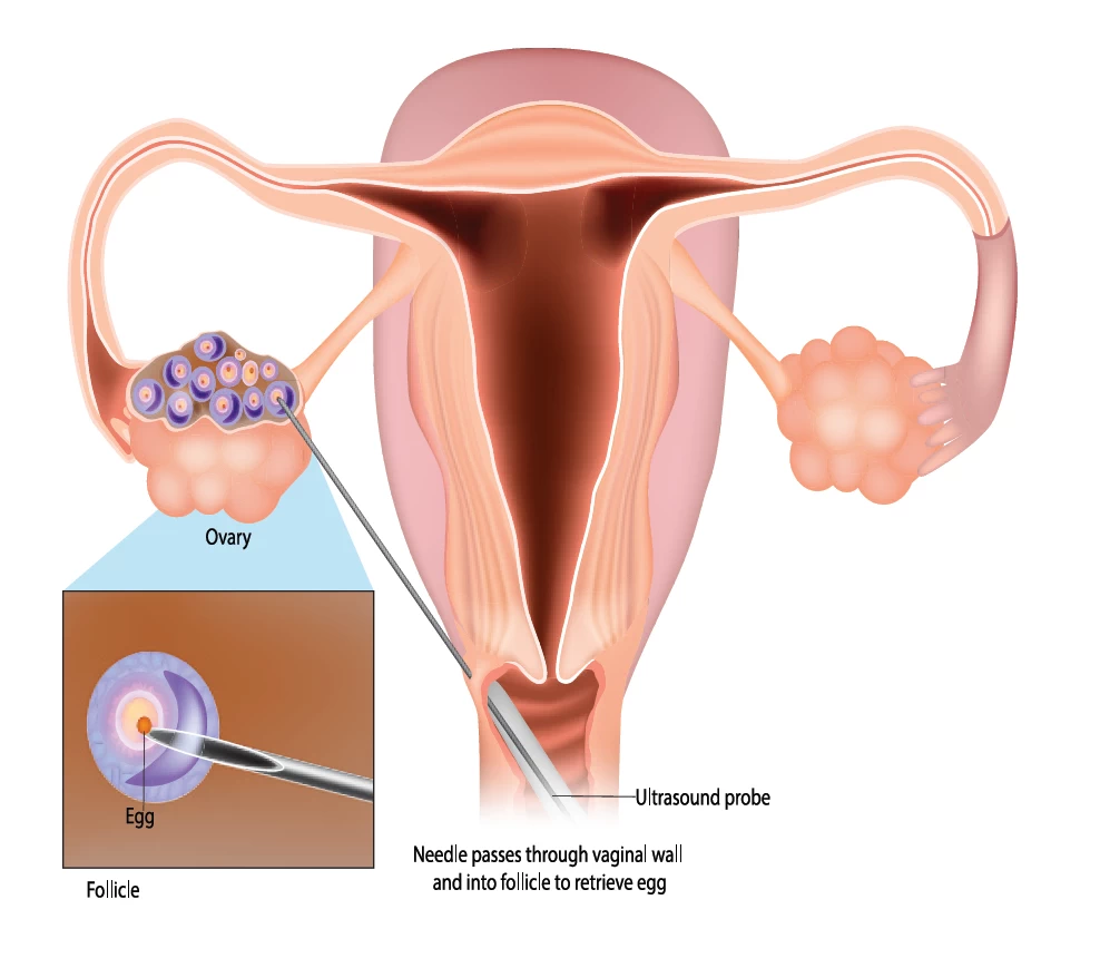 fig1-egg-donation.webp