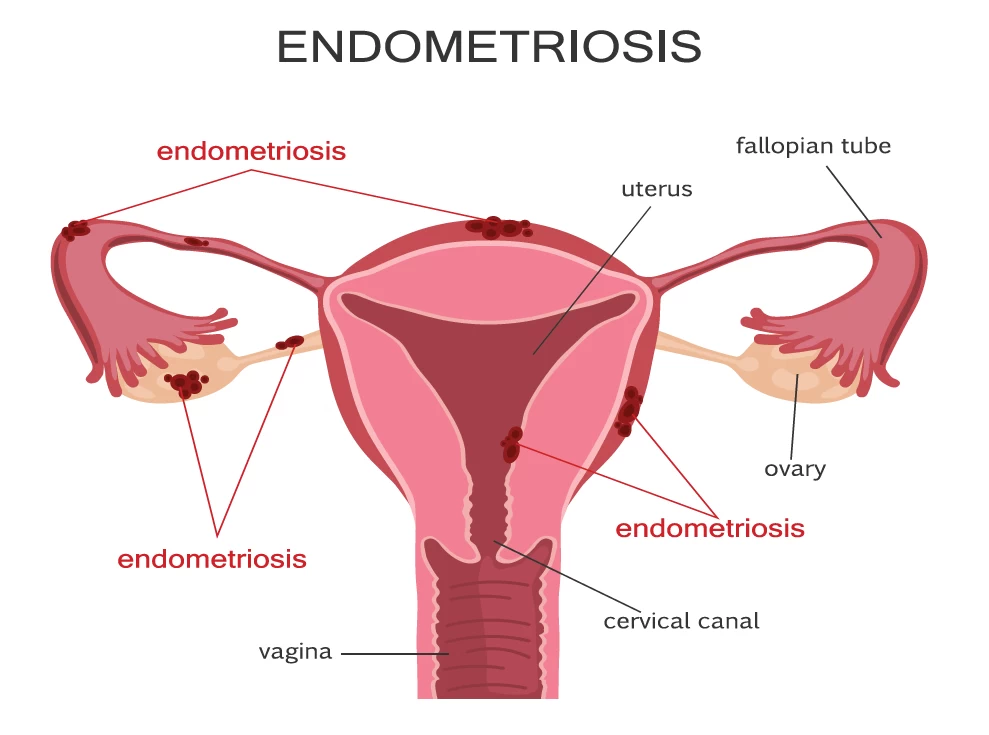 Fig1-endo-surgery.webp