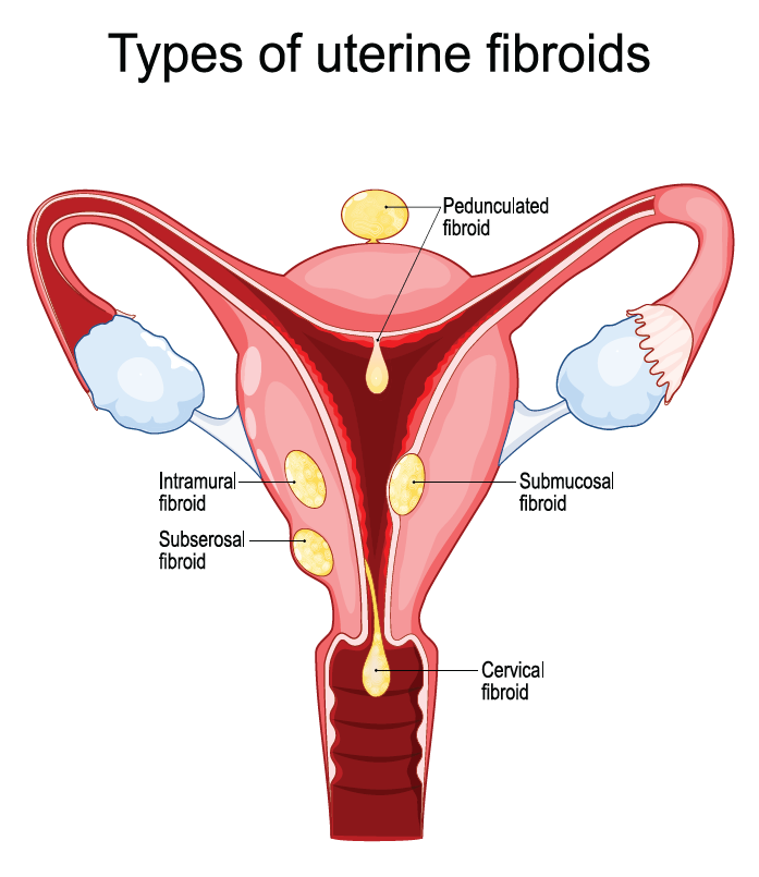 fig1-fibroids-and-fertility.png