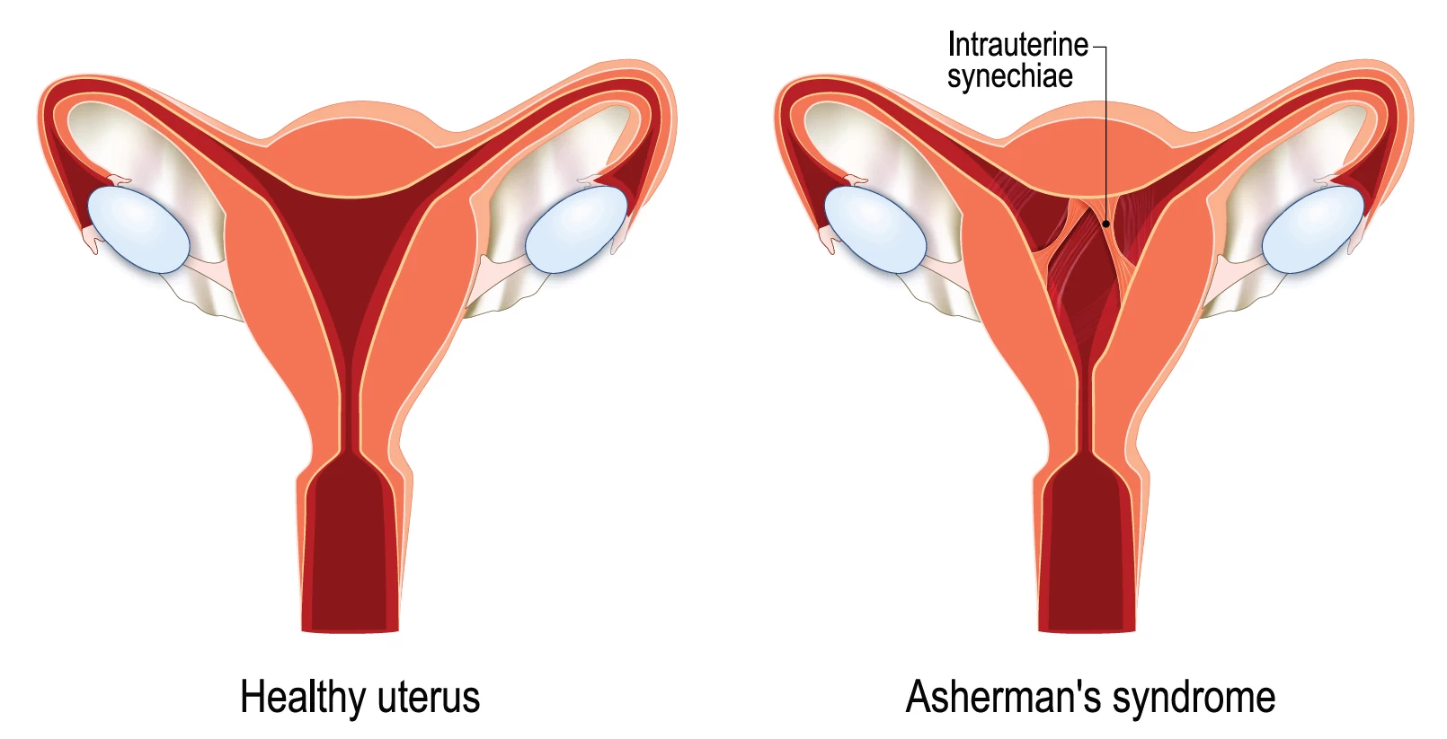 fig1-intrauterine-adhesions.webp