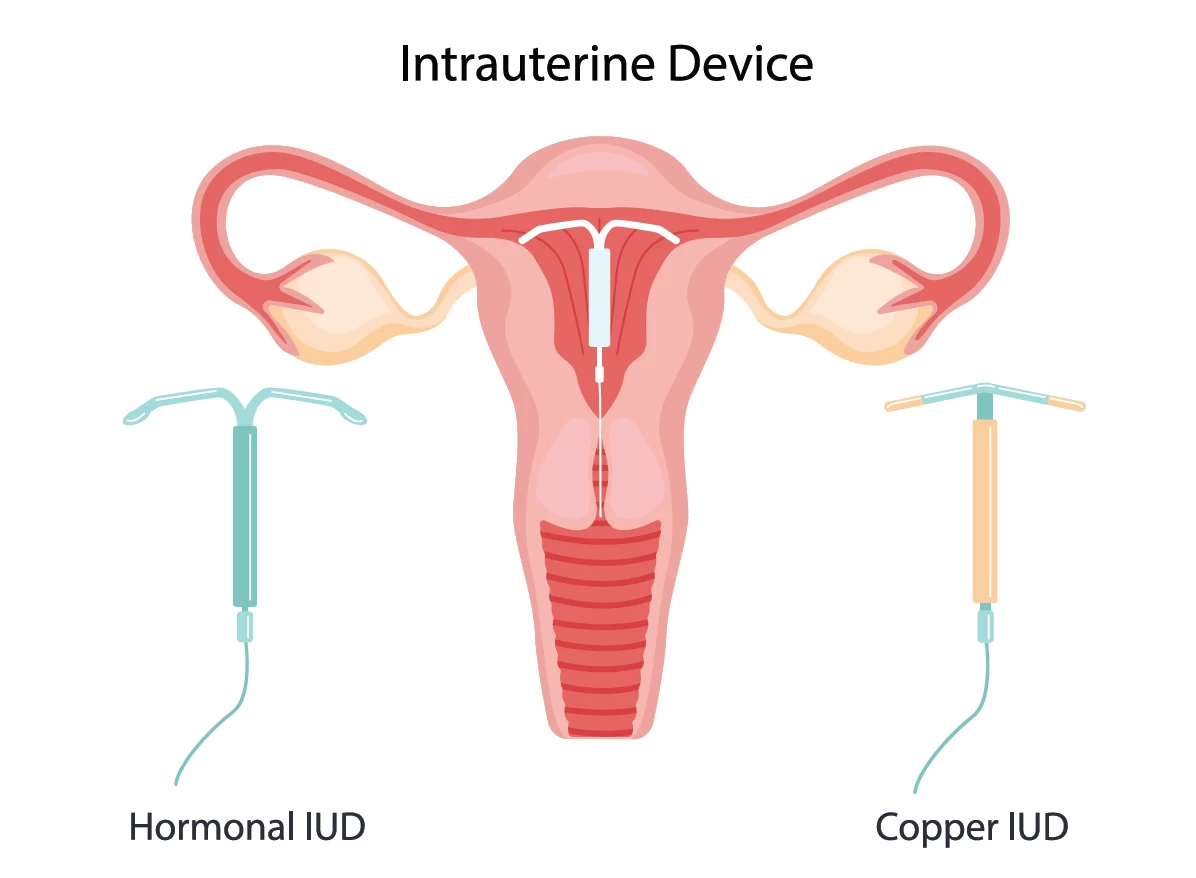 fig1-iud.webp