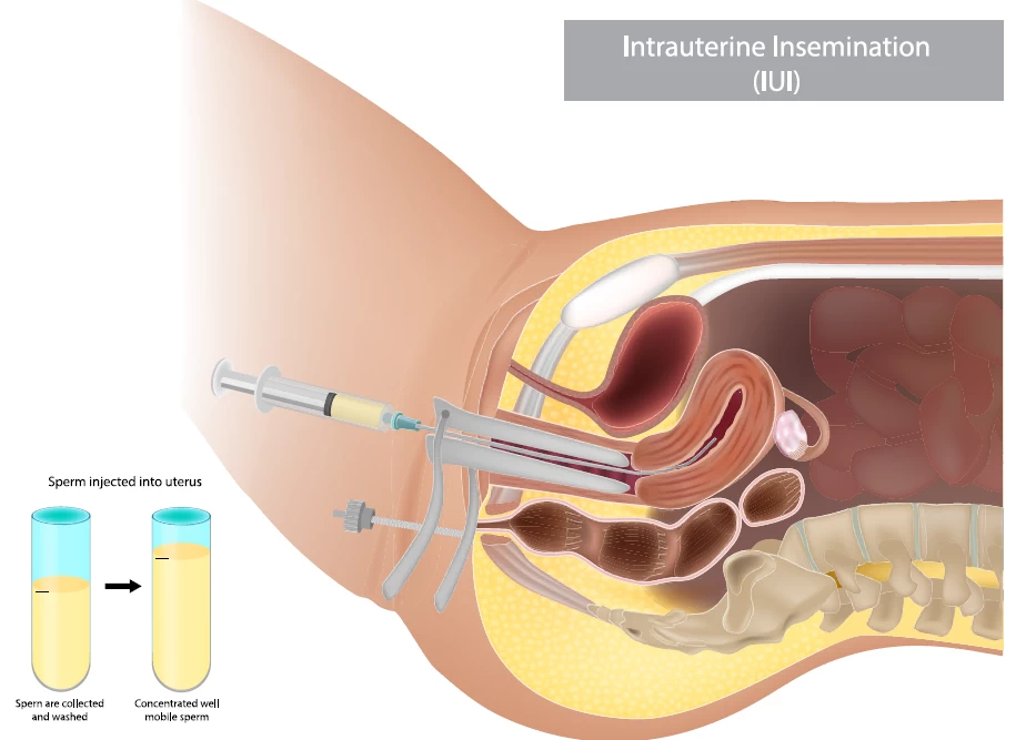 fig1-iui.webp