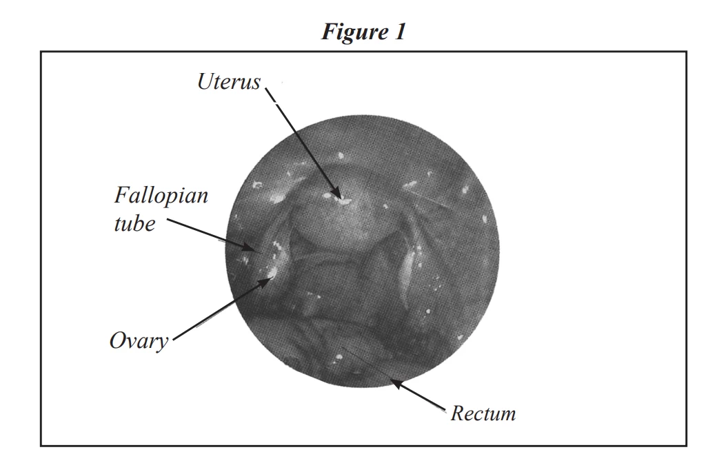 fig1-laparoscopy-hysteroscopy.webp