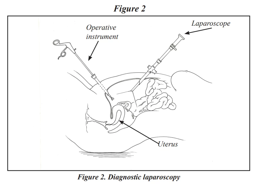 fig2-laparoscopy-hysteroscopy.webp