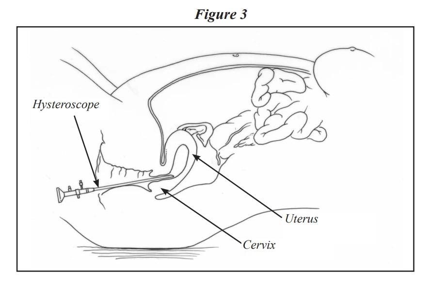 fig3-laparoscopy-hysteroscopy.webp