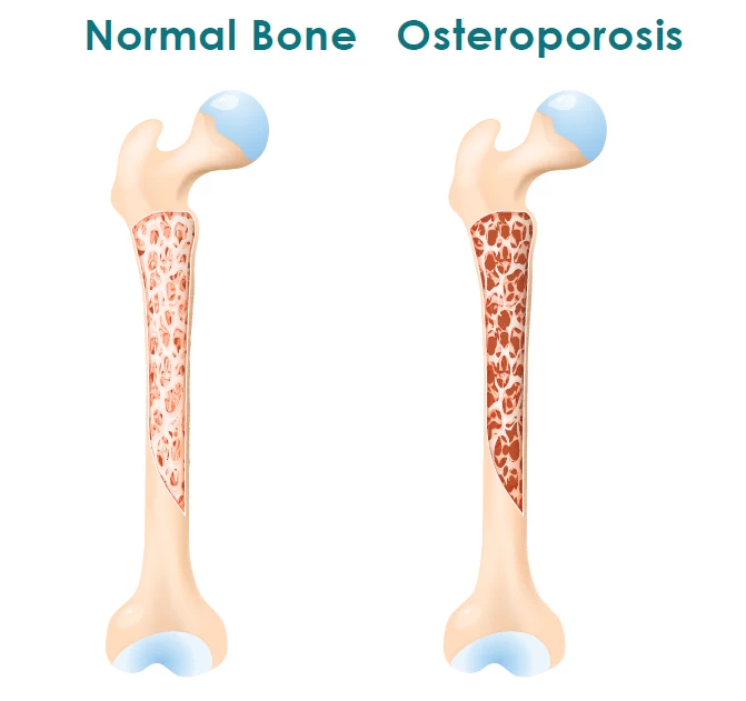 fig1-osteoporosis.webp