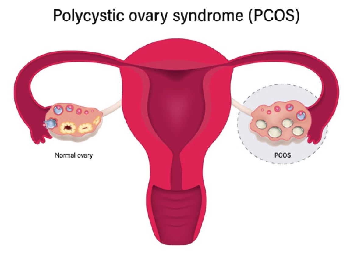 Fig1-pcos.webp