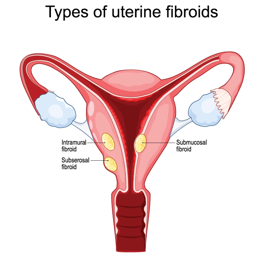 Fig1-what-are-fibroids.webp